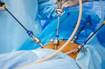 GENERAL / MINIMALLY INVASIVE ( LAPROSCOPIC ) SURGERY 